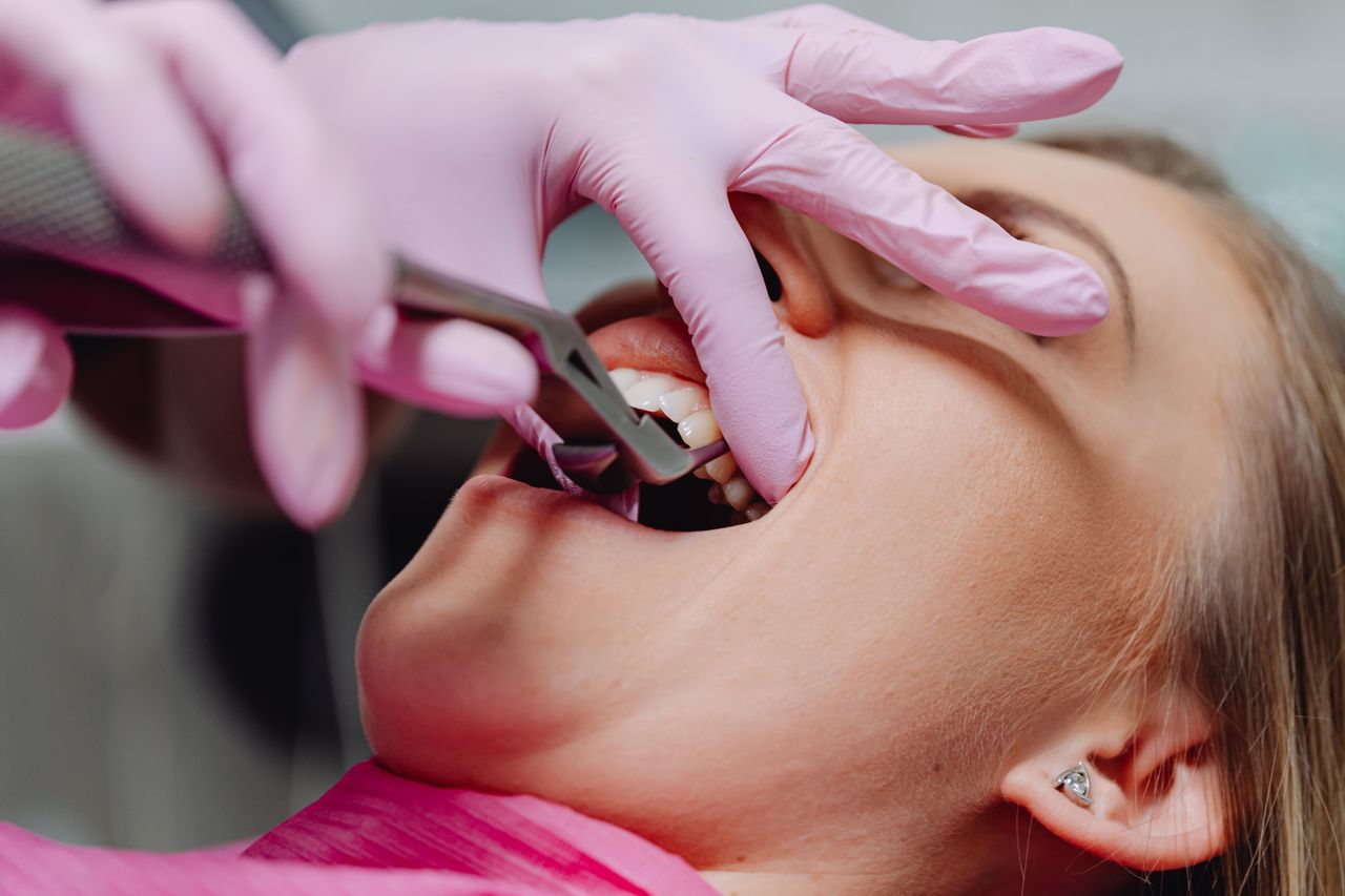 Otturazione saltata: cosa fare nell'attesa del dentista