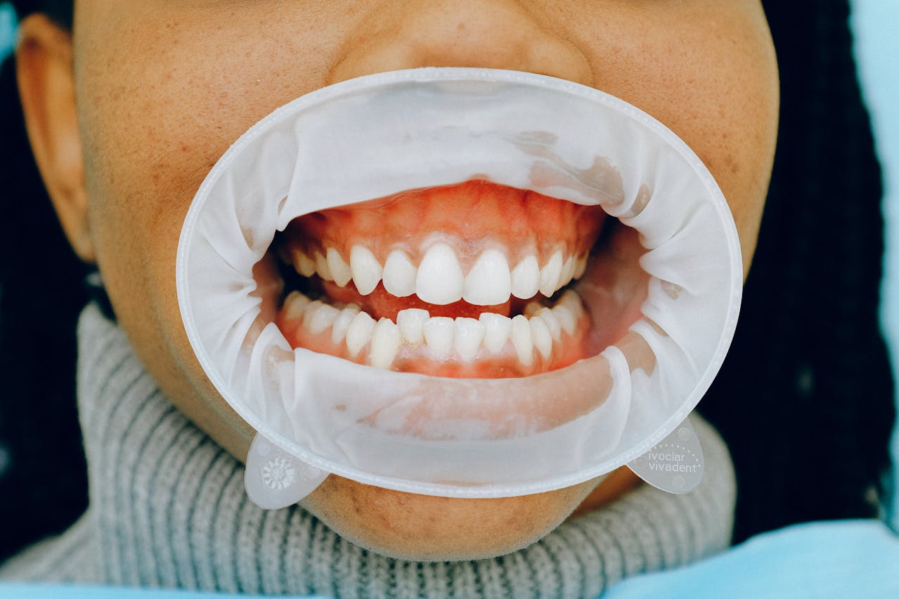 Macchie sui denti: quali sono innocue e quali vanno controllate