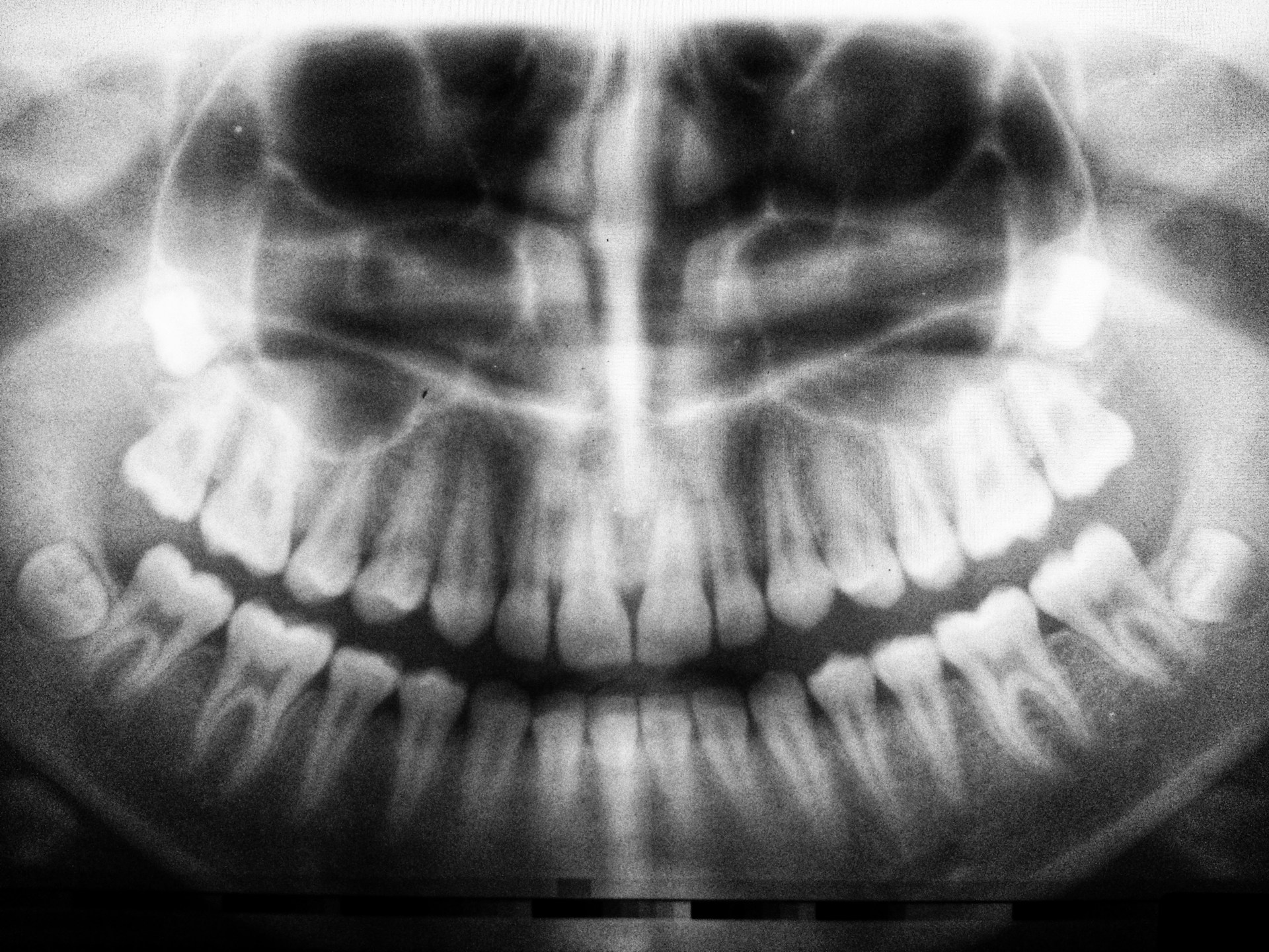 Denti del giudizio: quando toglierli e quando lasciarli stare
